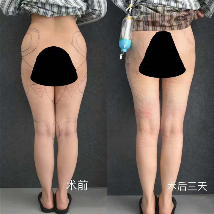 大腿部吸脂效果反馈