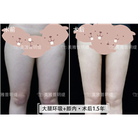 大腿环吸+膝内 1.5年术后反馈