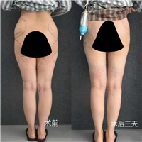 大腿部吸脂效果反馈