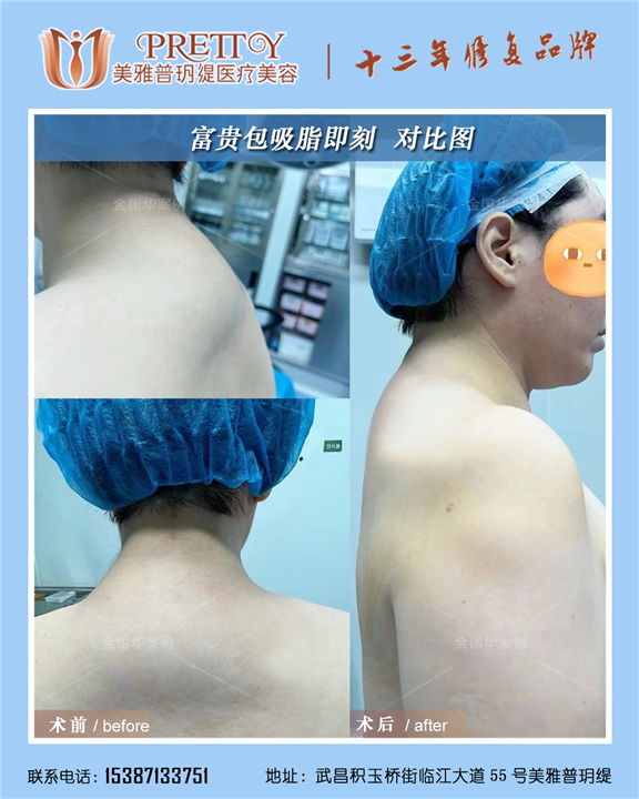 富贵包吸脂即刻对比图