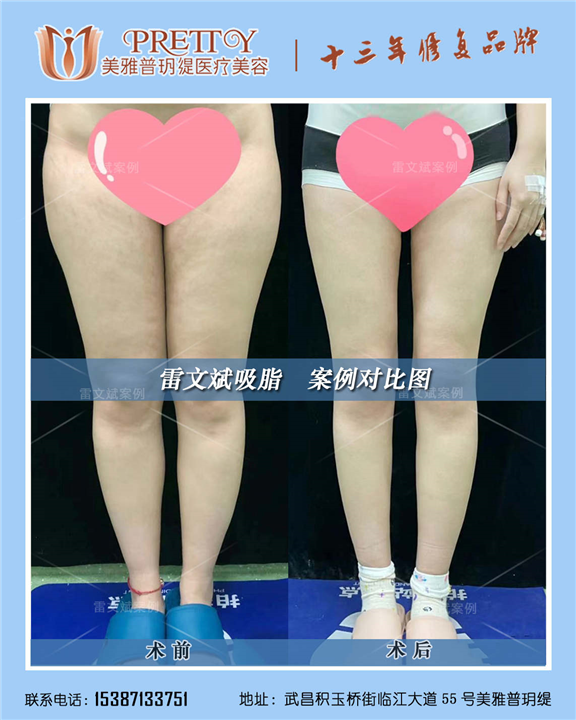 雷文斌大腿吸脂