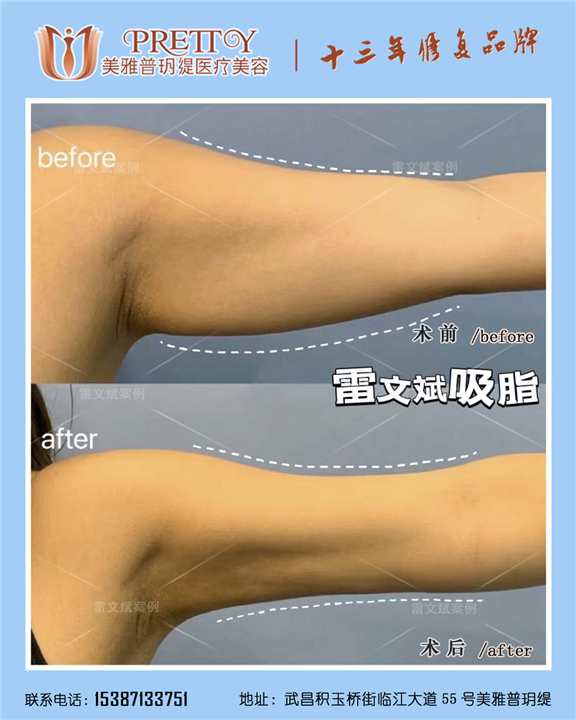 雷文斌吸脂