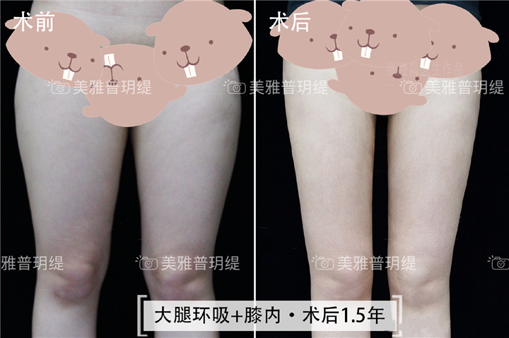 大腿环吸+膝内 1.5年术后反馈