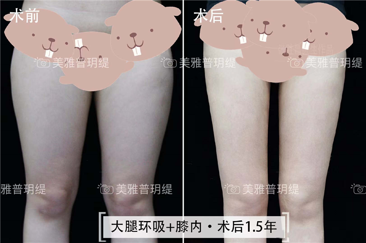 大腿环吸+膝内 1.5年术后反馈