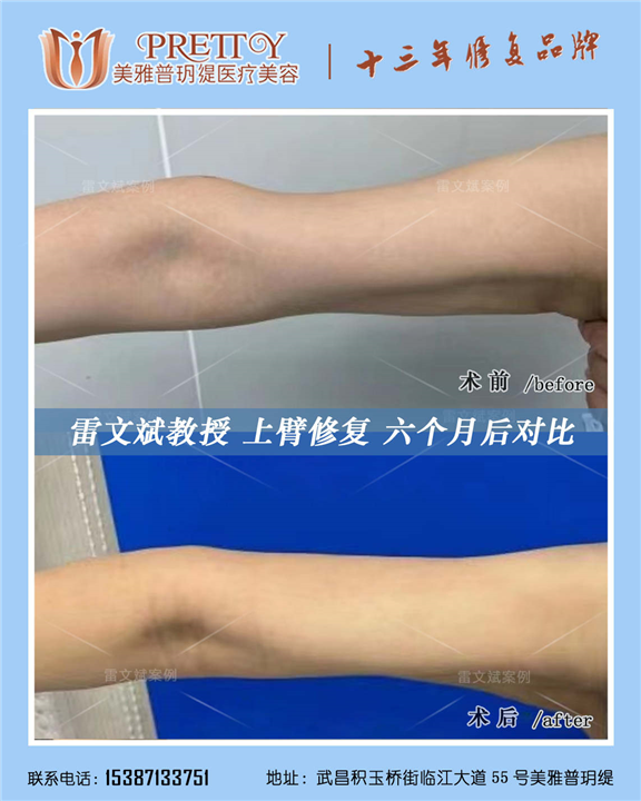 雷文斌教授上臂修复