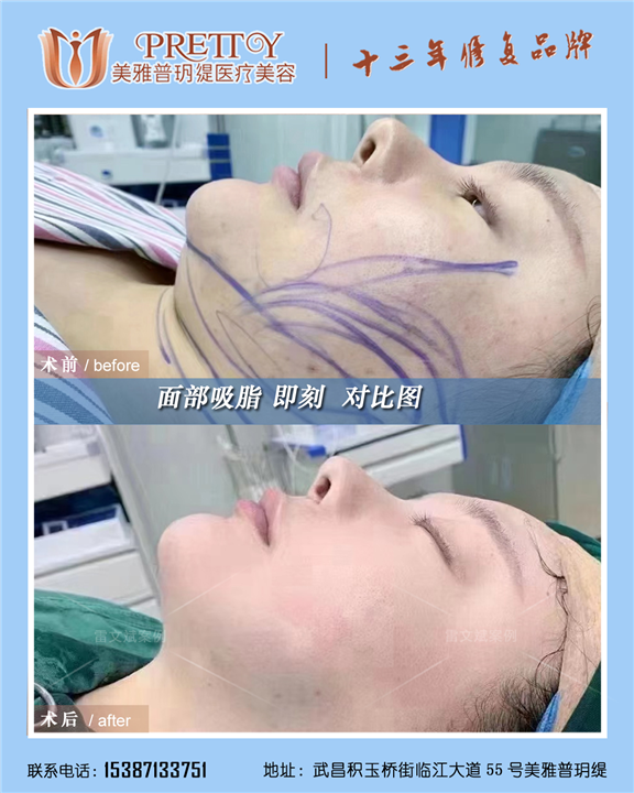 面部吸脂即刻