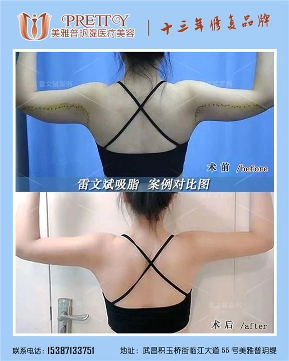 雷文斌医生背部吸脂