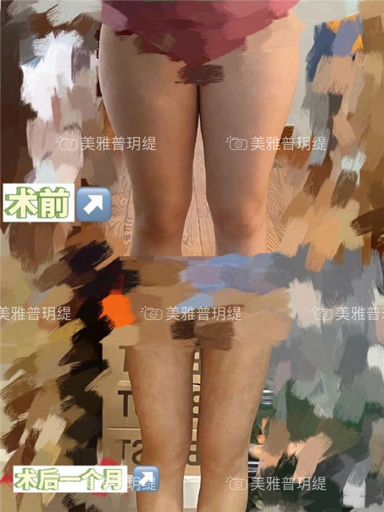 大腿吸脂术后一个月