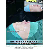 广州雅妍时光鼻修复