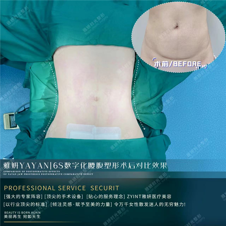广州腰腹吸脂整形