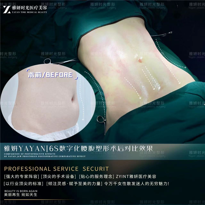广州腰腹塑形医院