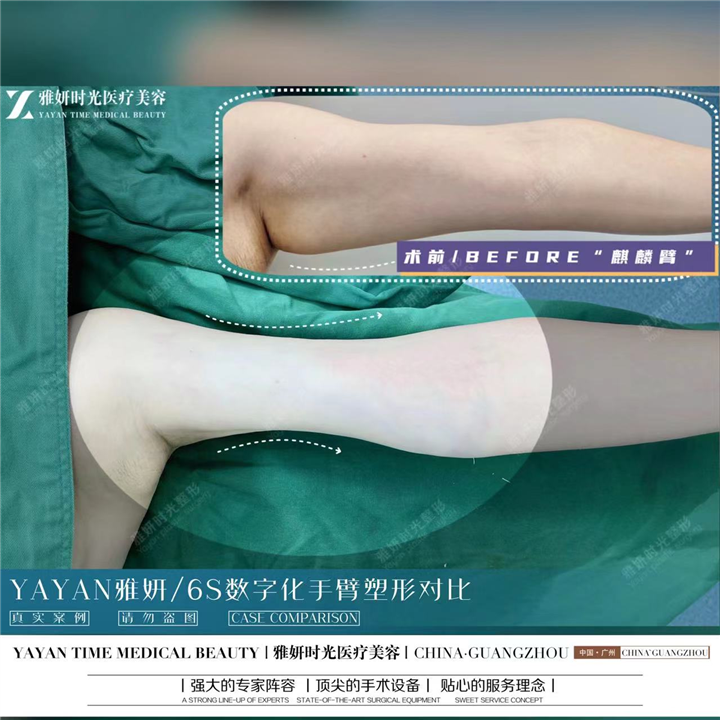 广州吸脂整形
