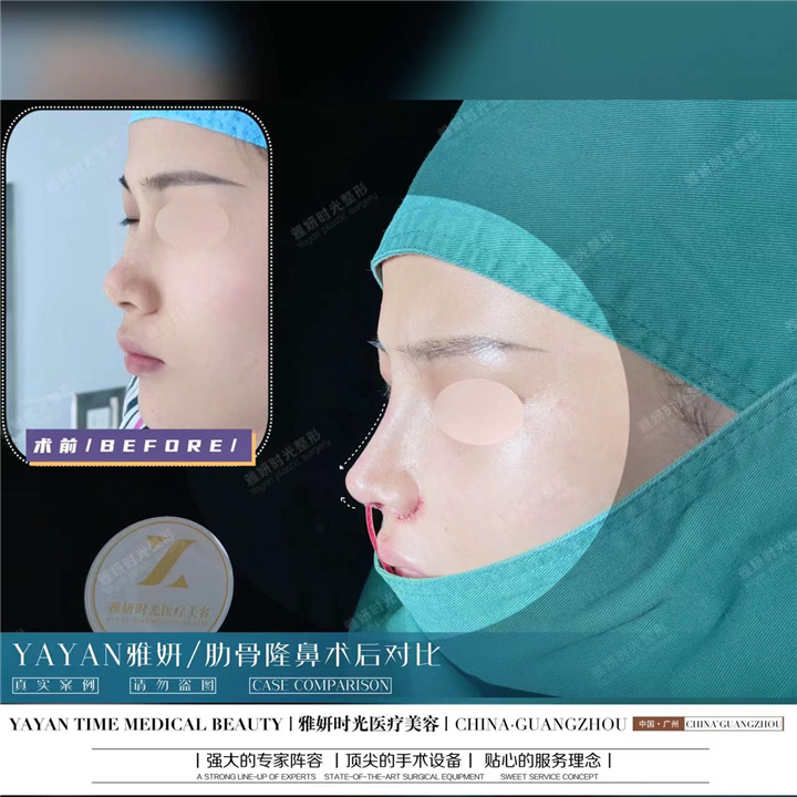广州鼻综合整形