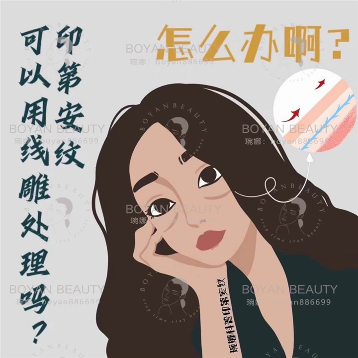 印第安纹剥离