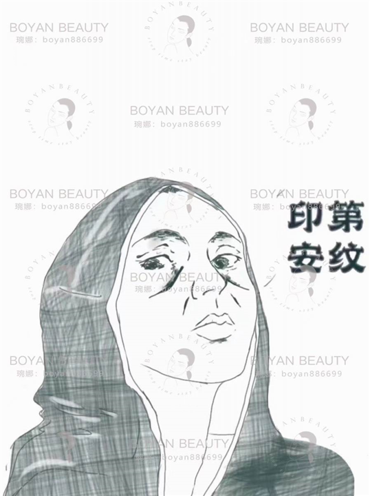 印第安纹剥离