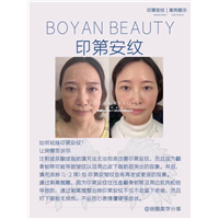 博妍剥离微雕