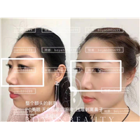 印第安纹剥离