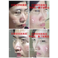 博妍剥离微整