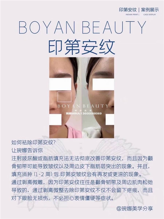 博妍剥离微雕