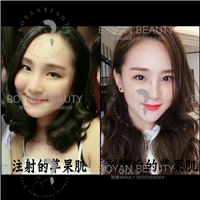 剥离苹果肌