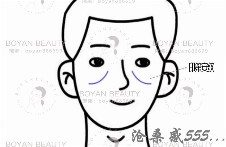 印第安纹剥离