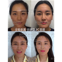 全脸剥离祛眼袋pc美眼