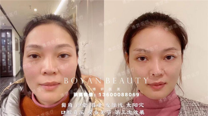 博妍剥离微整
