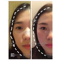 剥离咬合关节