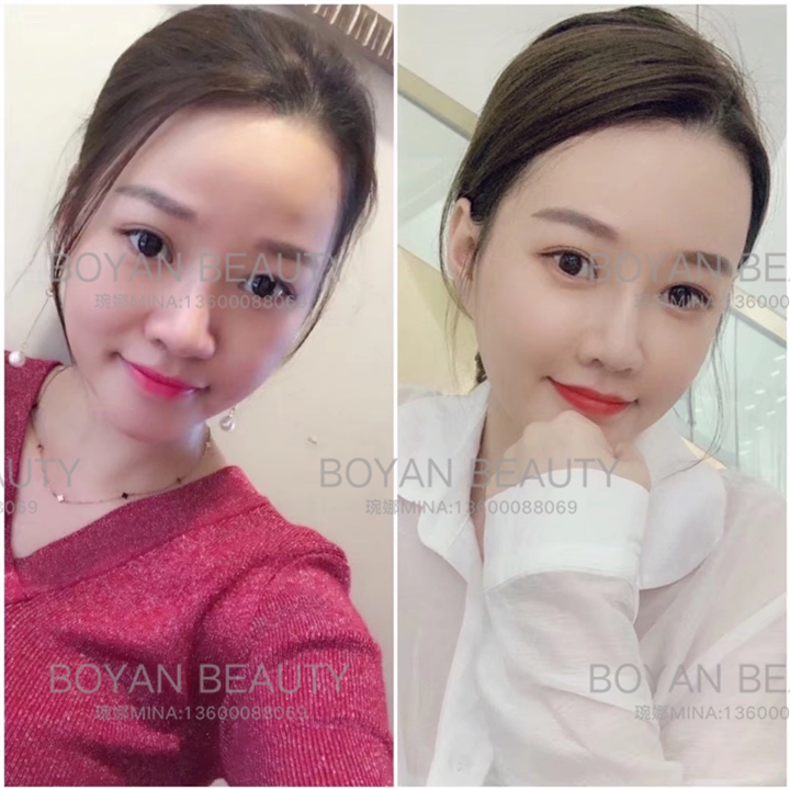 剥离微雕