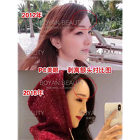 额头做剥离能去抬头纹吗