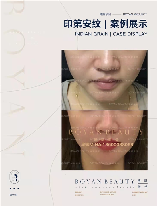 印第安纹剥离