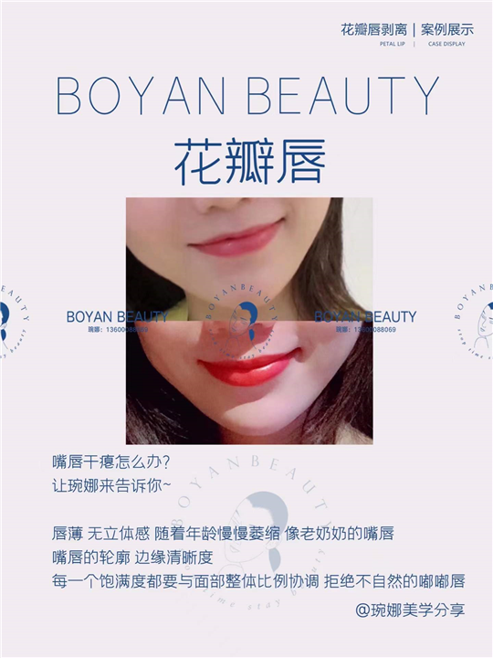 剥离花瓣唇