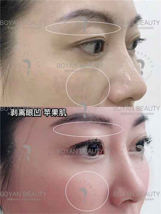 剥离苹果肌
