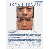 印第安纹剥离