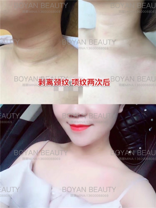 剥离颈纹