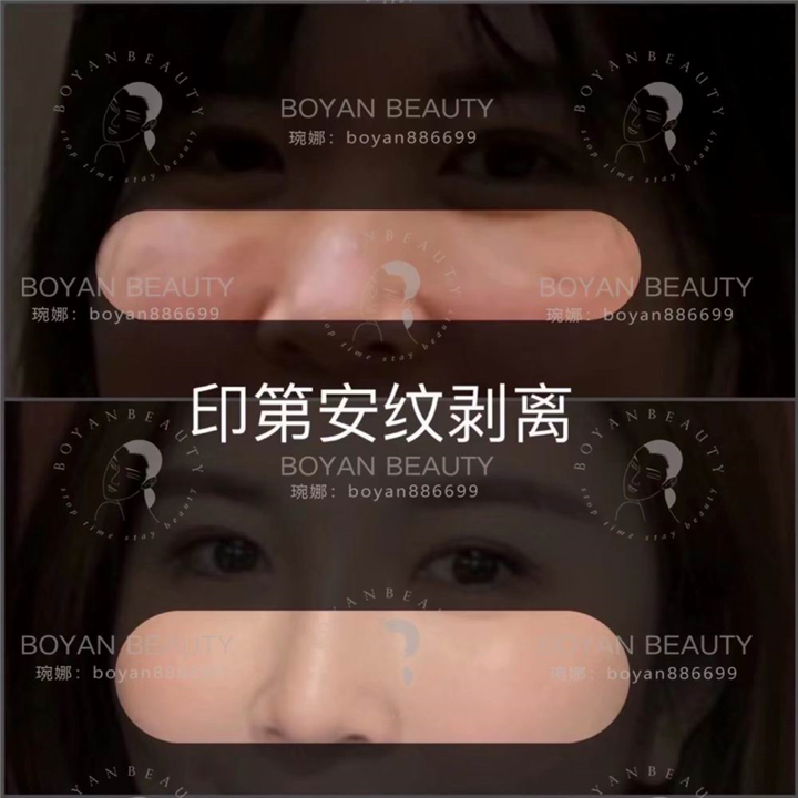 博妍剥离微整
