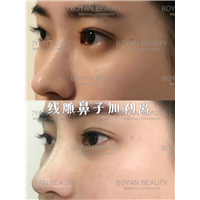 线雕剥离鼻子
