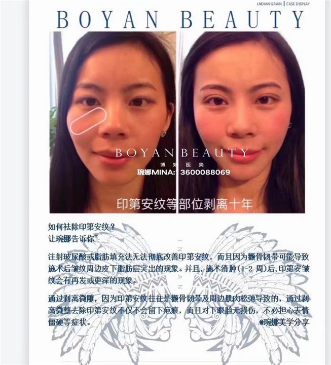 博妍剥离微整