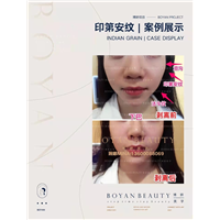 印第安纹剥离