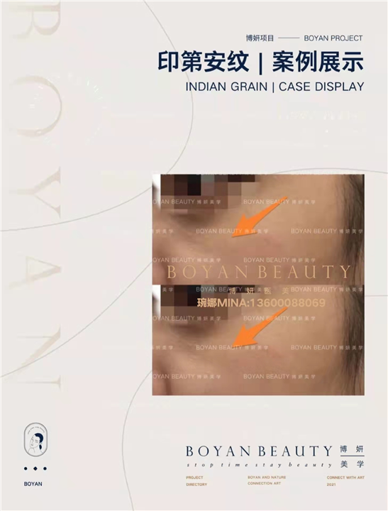 印第安纹剥离