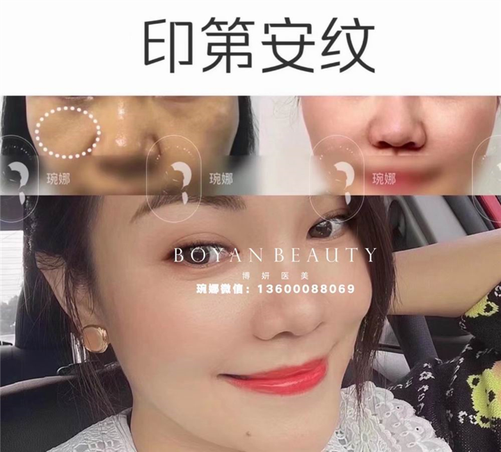 博妍剥离微整