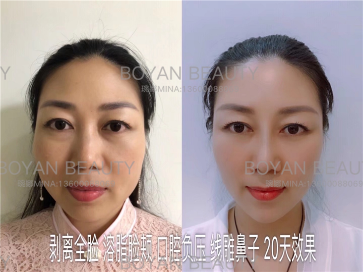 剥离微雕