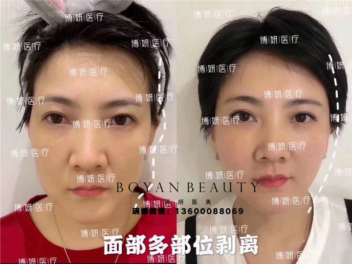 博妍剥离微整