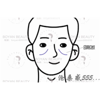 印第安纹剥离