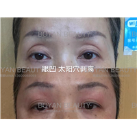 剥离眼凹