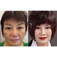 博妍剥离微整