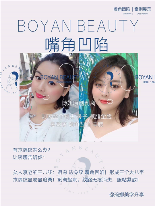 嘴角凹陷