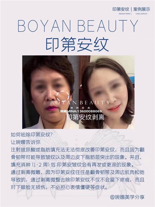 博妍剥离微雕