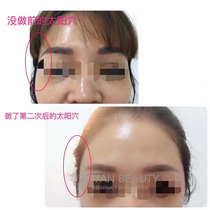 剥离太阳穴