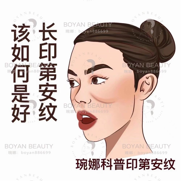 印第安纹剥离
